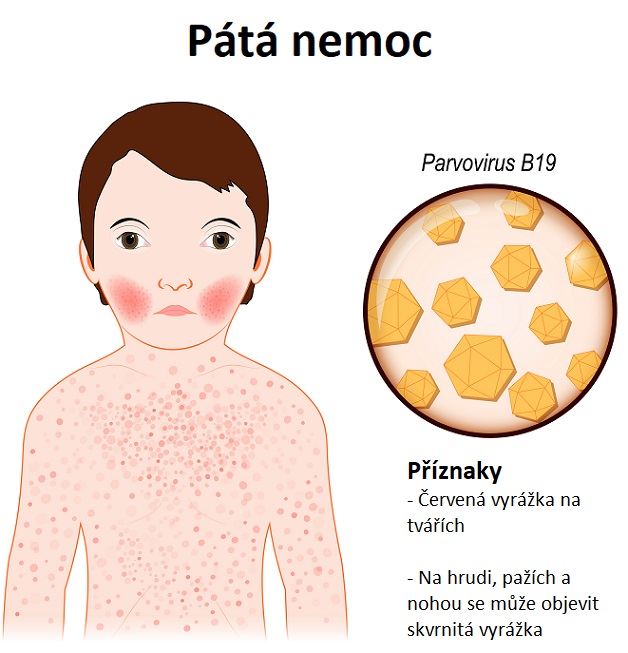 Pátá nemoc - ilustrace