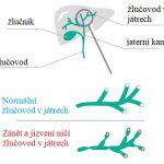 Primární biliární cirhóza – poškození žlučových cest v játrech – příznaky, příčiny a léčba