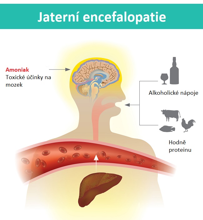 Jaterní encefalopatie - ilustrace