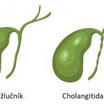 Cholangitida – zánět žlučových cest – příznaky, příčiny a léčba